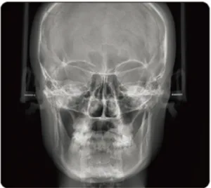 Posteroanterior Cephalogram:
